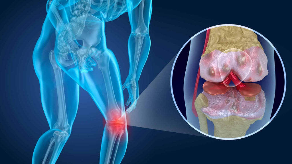Comment soulager l’arthrose naturellement ?