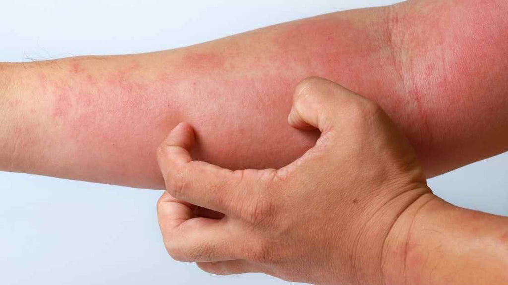 Comment traiter la dermite séborrhéique ?