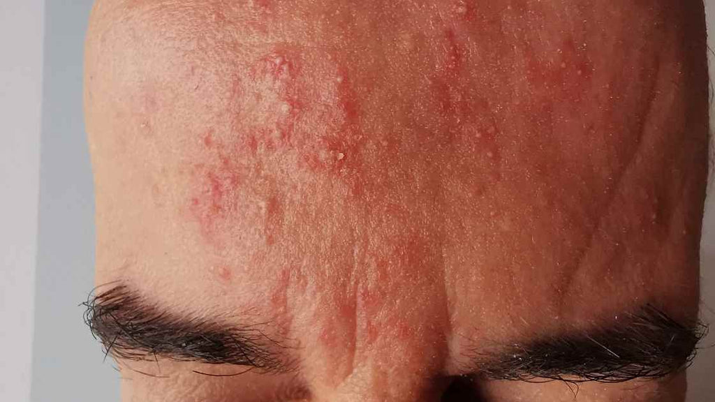 Quel remède efficace pouvez-vous nous conseiller pour l’acné rosacé ?
