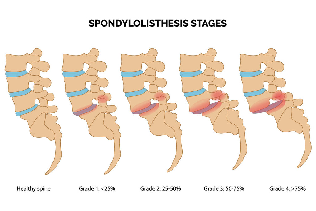 Comment soulager une spondylothesis ?