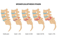 Comment soulager une spondylothesis ?